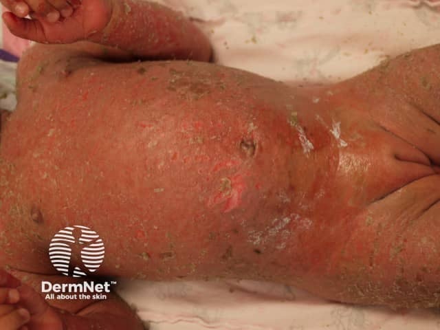 Staphylococcal scalded skin syndrome