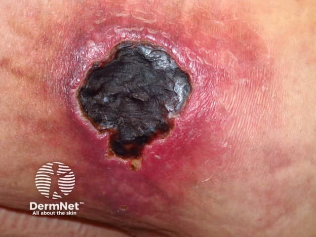 Calciphylaxis