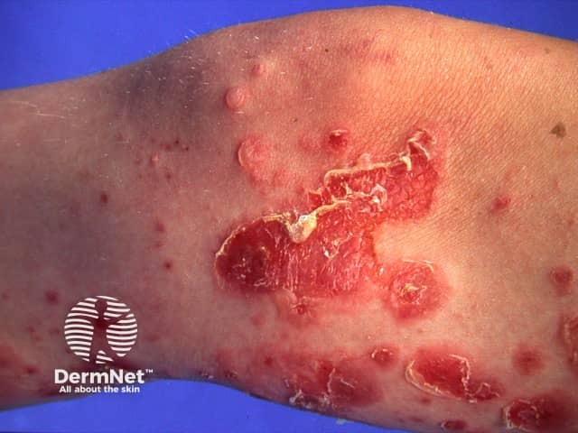 Bullous impetigo