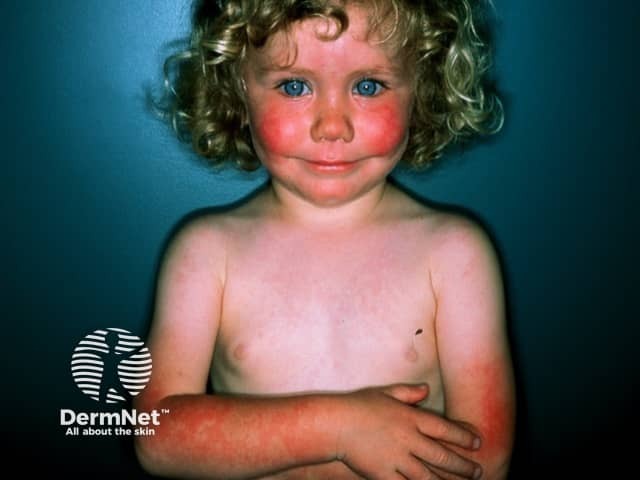 Erythema infectiosum / fifth disease