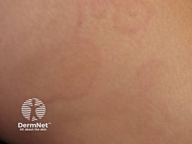 ­Erythema marginatum