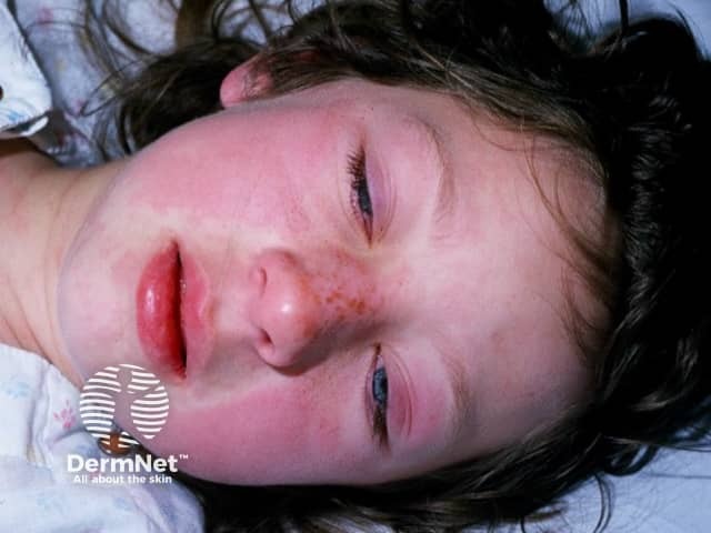 Kawasaki disease