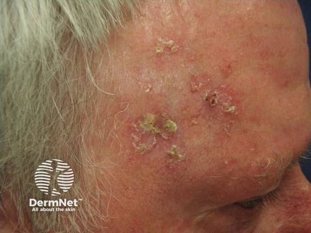 Actinic keratoses