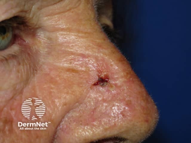 Basal cell carcinoma