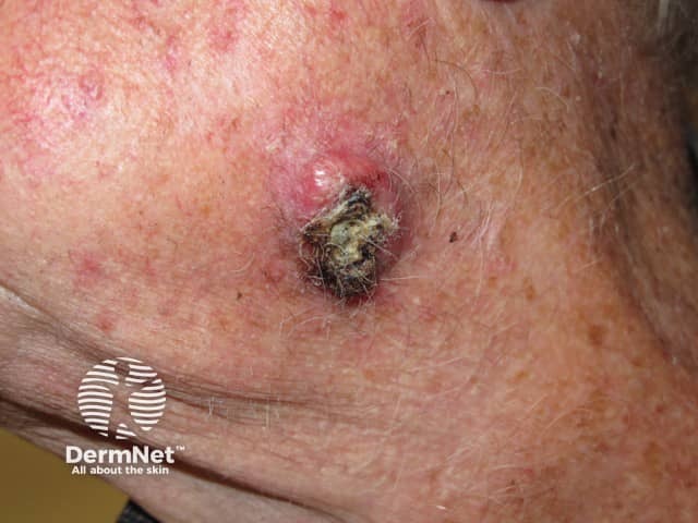 Squamous cell carcinoma