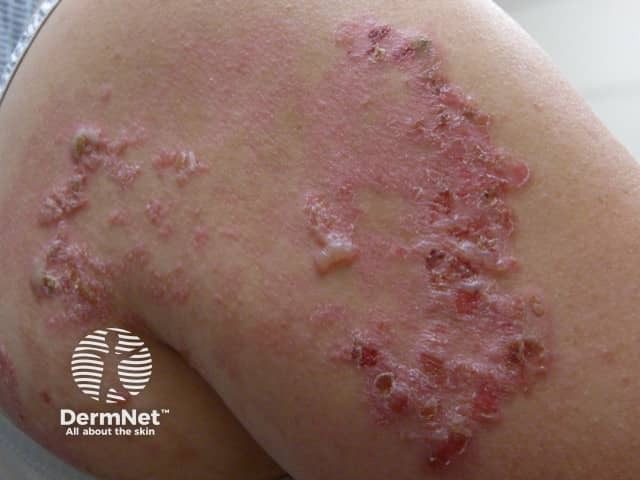 Epidermolysis bullosa