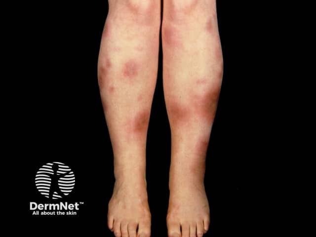 Erythema nodosum