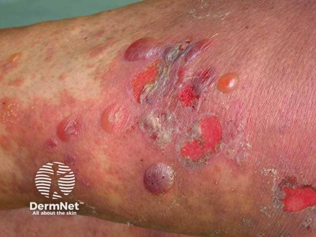 Bullous pemphigoid