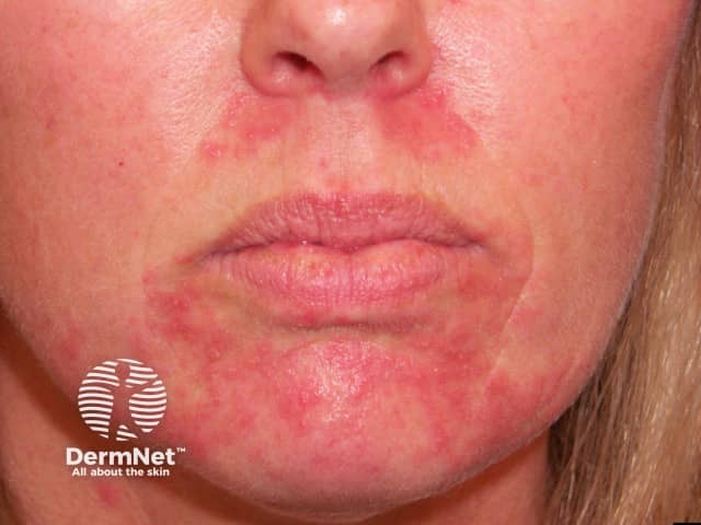 Perioral/periorificial dermatitis