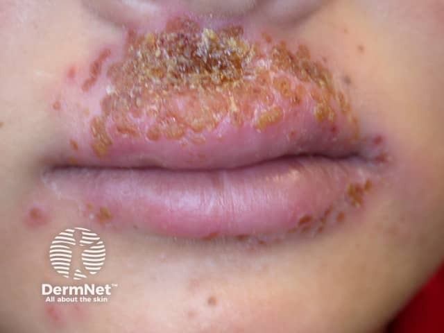 Herpes simplex