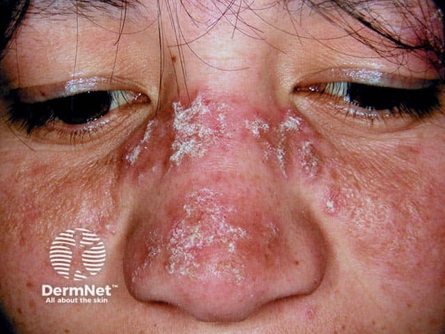 Discoid lupus erythematosus