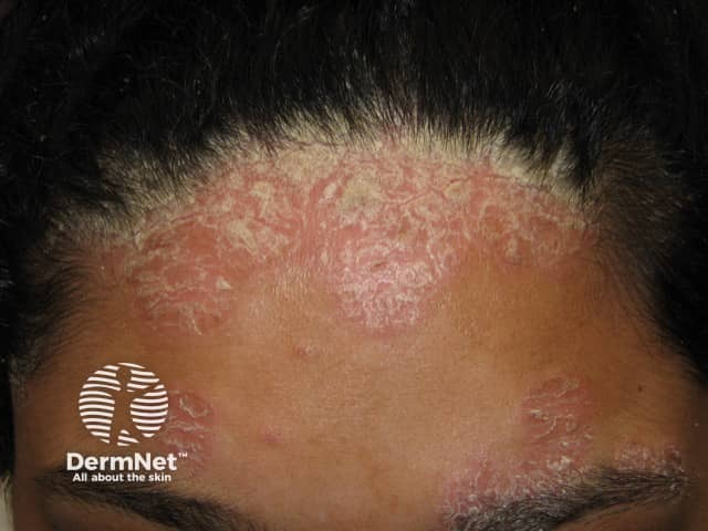 Psoriasis