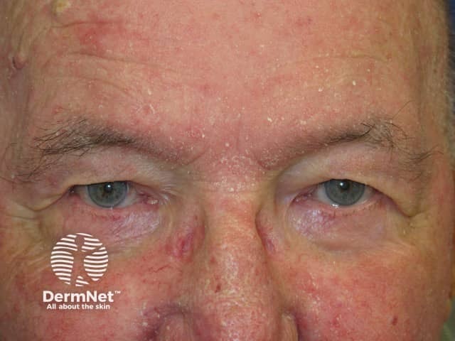 Seborrhoeic dermatitis