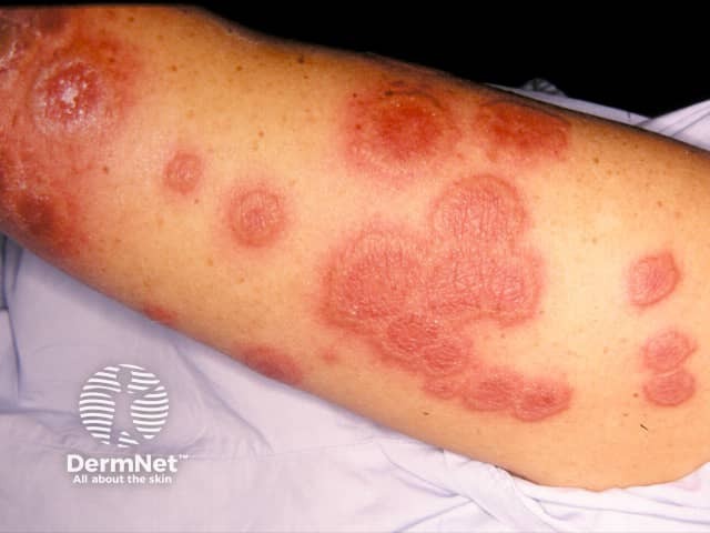 Acute febrile neutrophilic dermatosis