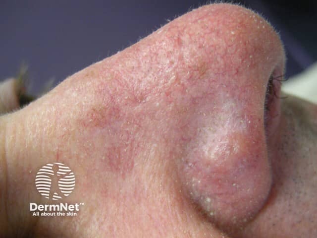 Granuloma faciale