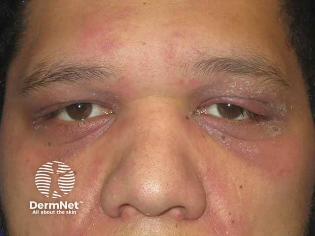 Dermatomyositis