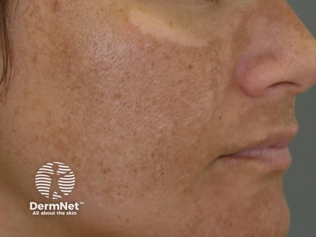 Melasma