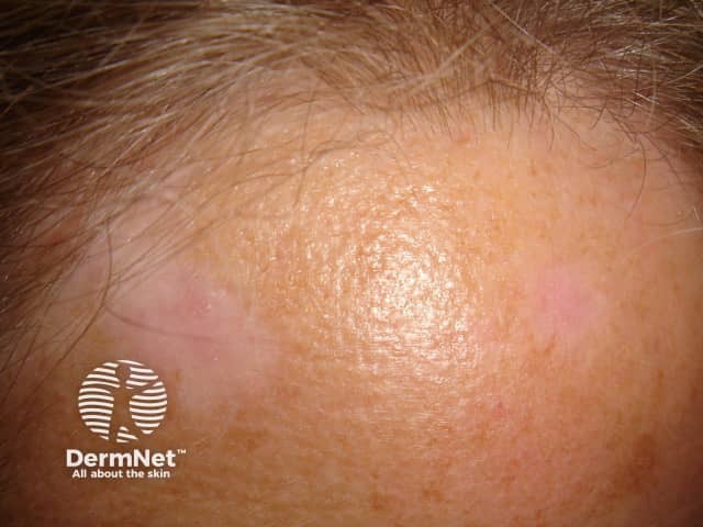 Post-inflammatory hypopigmentation