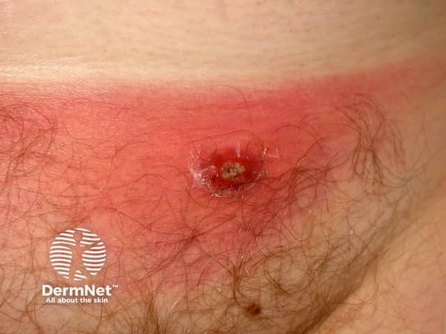 Folliculitis/furunculosis