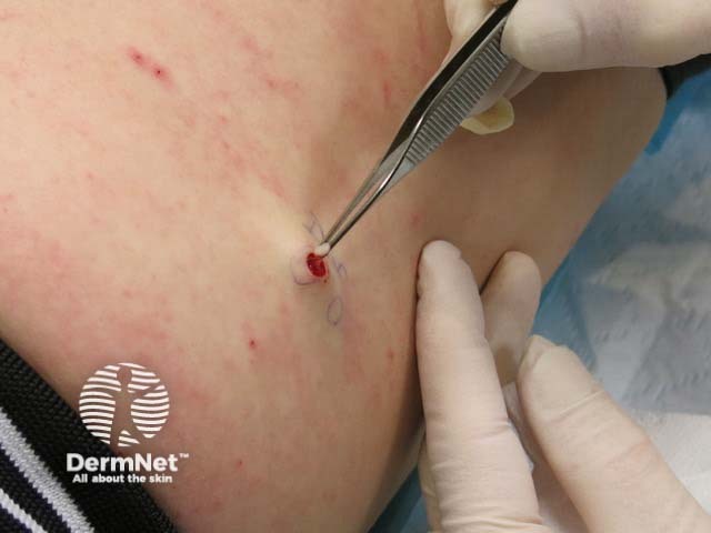 Skin biopsy for histopathology