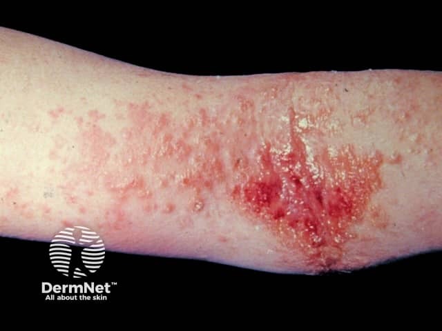 Atopic dermatitis