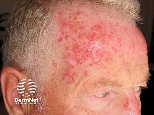 Effect of 17 days of fluorouracil cream to actinic keratoses