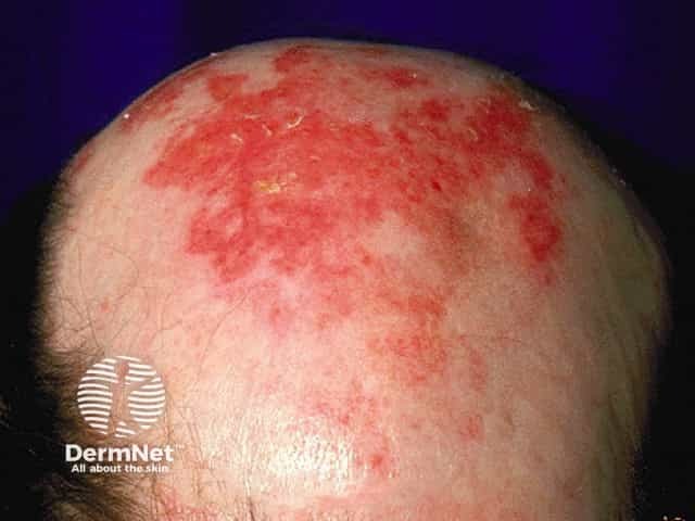 Effects of fluorouracil cream applied to actinic keratoses