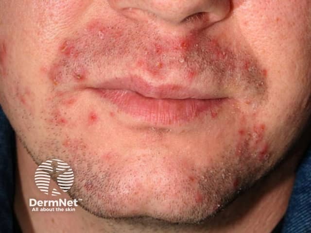 A bacterial infection of the beard area follicles - folliculitis barbae