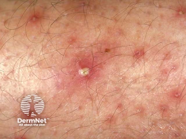 Folliculitis