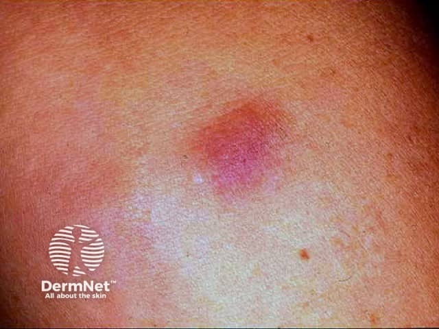 Bovine collagen granuloma