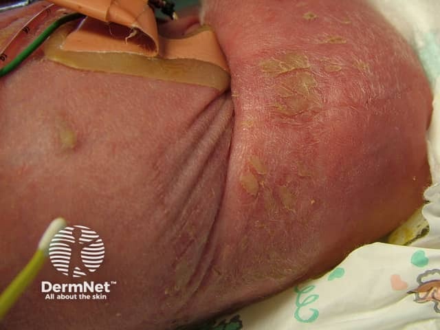 Cutaneous aspergillosis