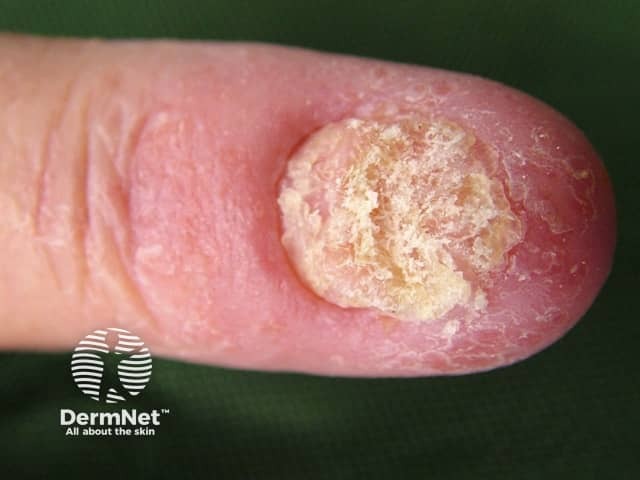 Candidal nail infection