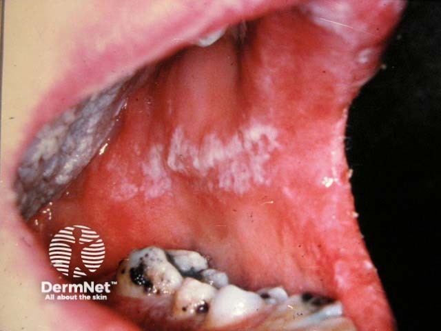 Oral candidiasis