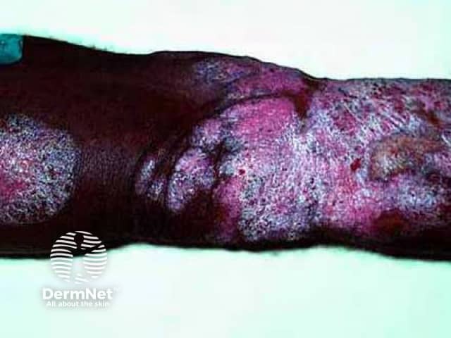 Chromoblastomycosis