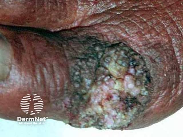 Chromoblastomycosis