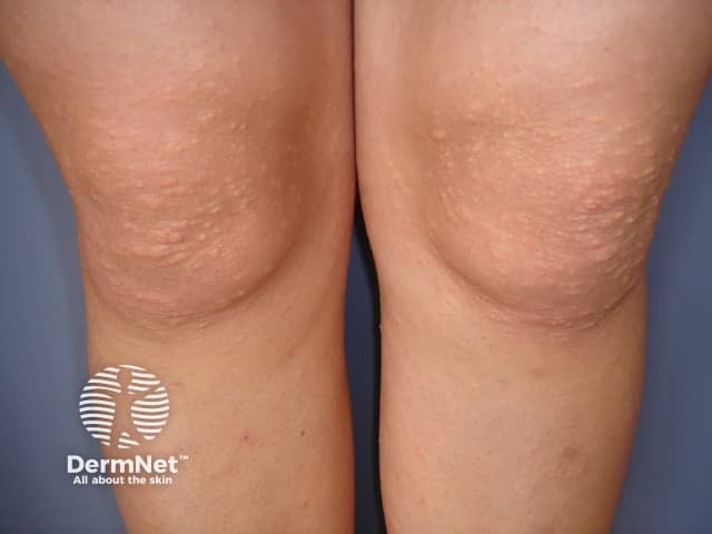 Clusters of papules on knees