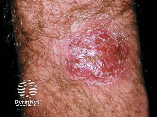 Kerion - inflammatory tinea corporis