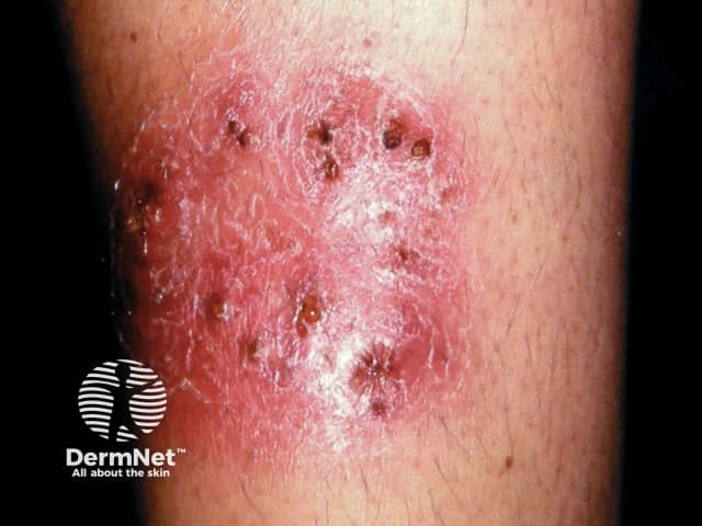 Majocchi granuloma - invasive tinea corporis