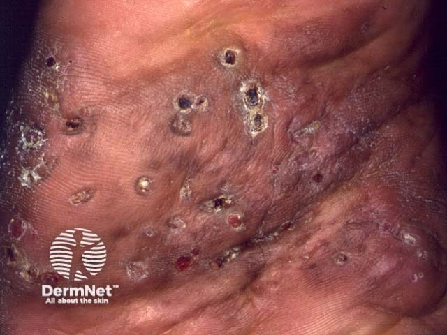 Actinomycetoma due to nocardia