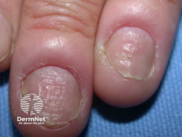 Nailfold swelling