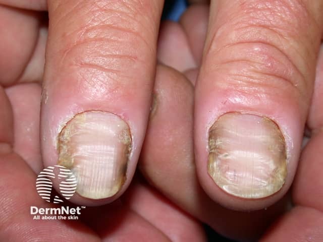 Nail dystrophy