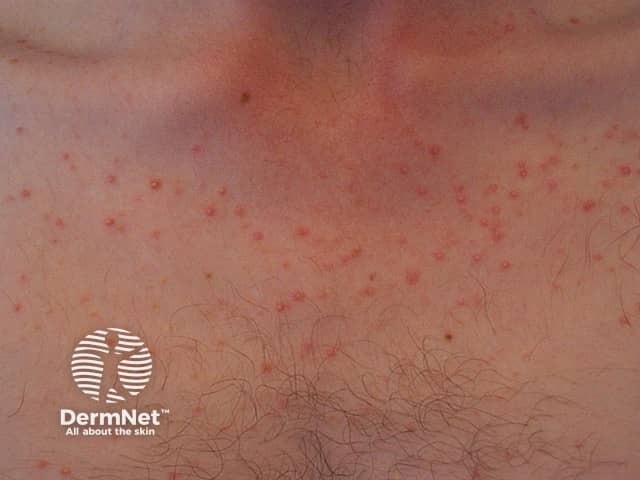 Malassezia folliculitis