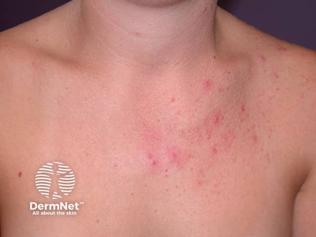 Malassezia folliculitis