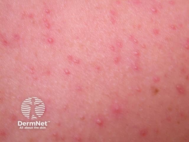 Malassezia folliculitis