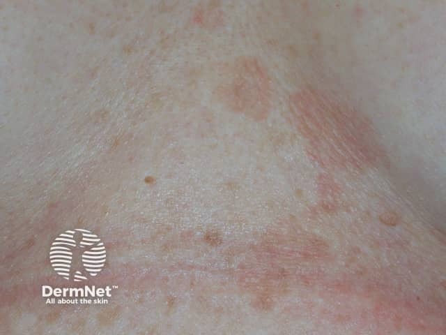 Pityriasis versicolor