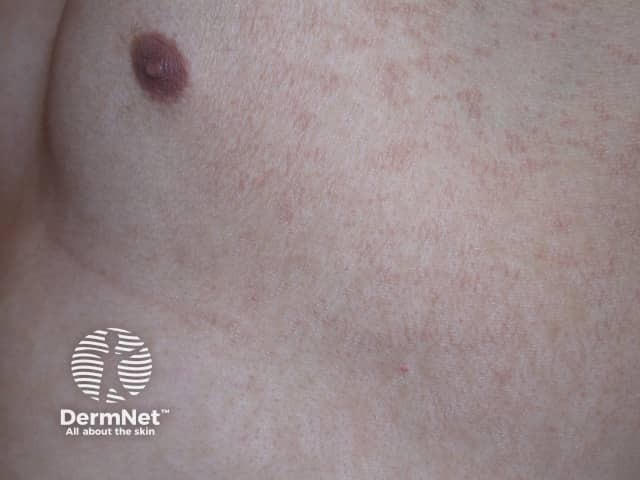 Pityriasis versicolor