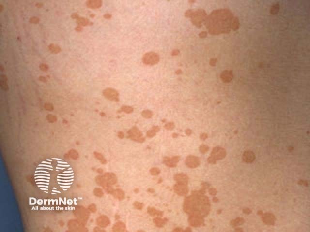 Pityriasis versicolor