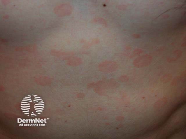 Pityriasis versicolor