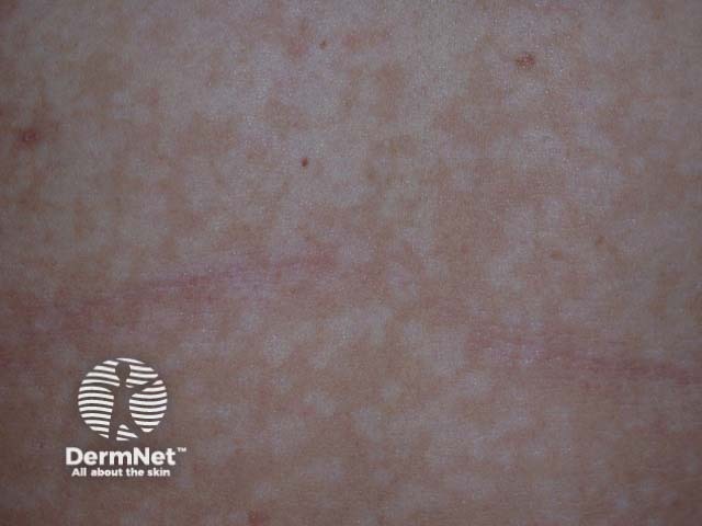 Pityriasis versicolor