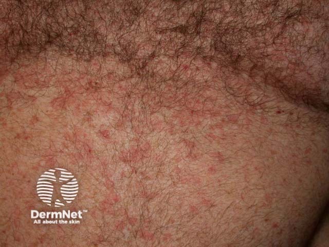 Pityriasis versicolor